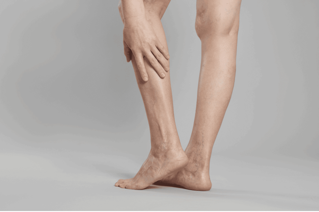 Varicose vein procedures Andalusia Alabama