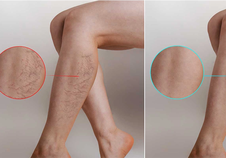 Varicose vein procedures in Andalusia-Alabama